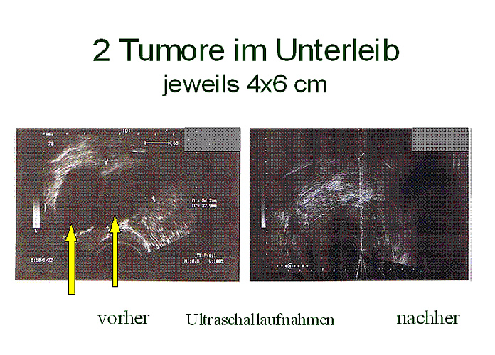 Zwei Tumore im Unterleib